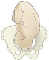 <p>What fetal position is this? </p><p>Assuming: R|L</p>