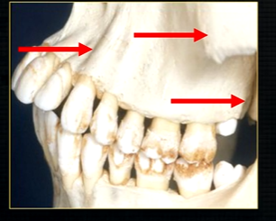<ul><li><p>bony undulation over the canine root that is especially prominent </p></li></ul><p></p>