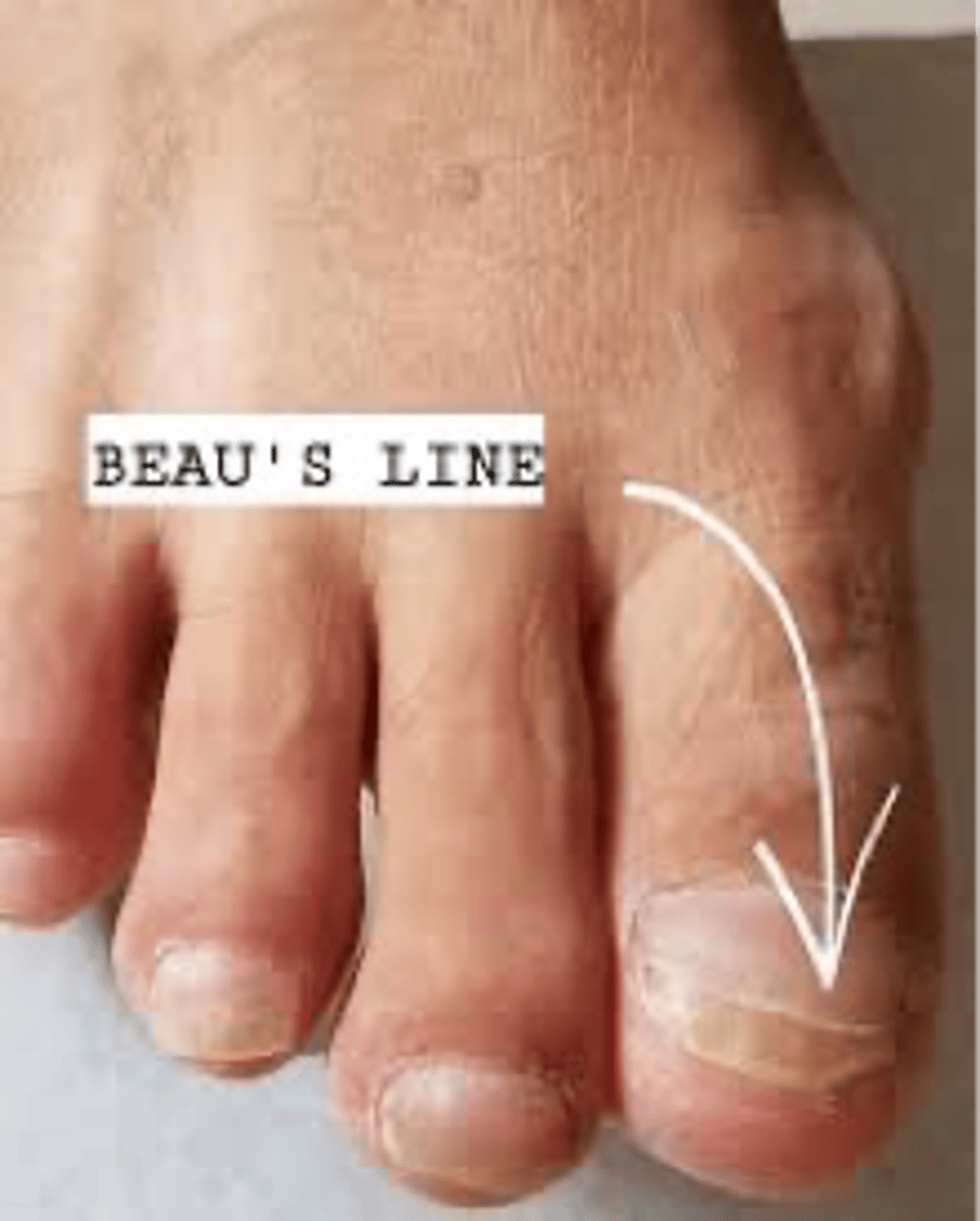 <p>◦Transverse depressions in the nails associated with acute or severe illness</p><p>◦Grow out with time</p>