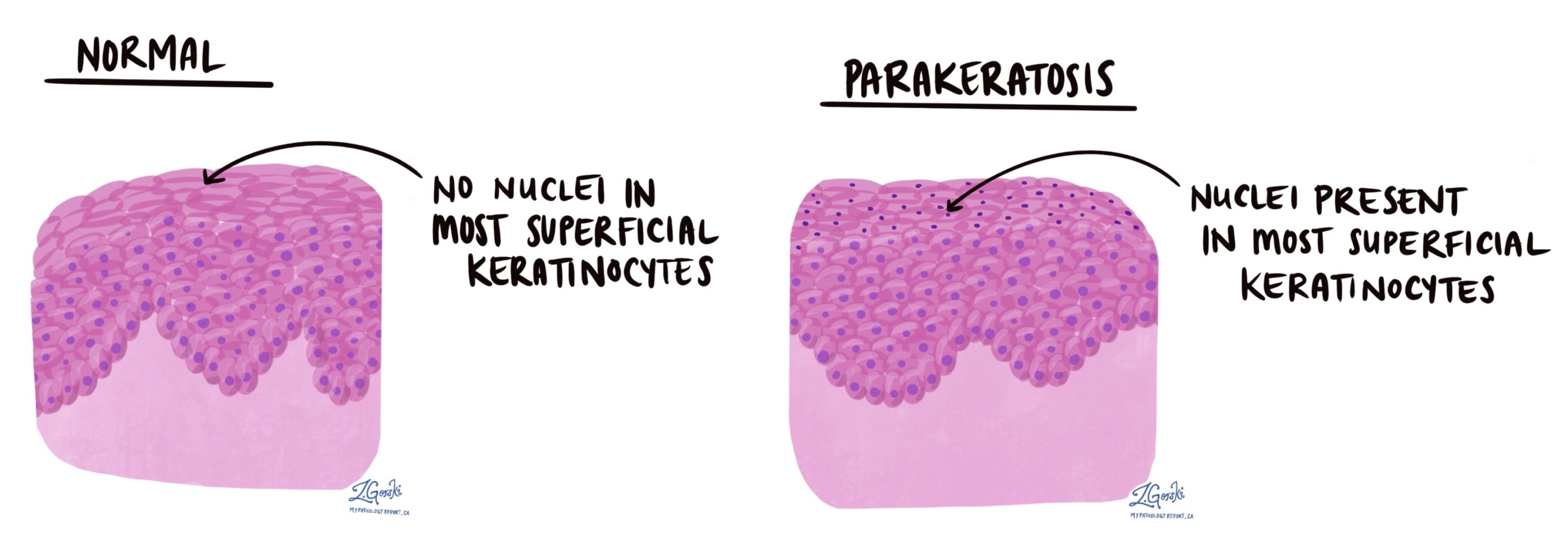 <ul><li><p>Parakeratosis is a disorder of keratinisation where cells retain their nuclei</p></li><li><p>Hyperkeratosis is the excessive thickening of the stratum corneum due to increased keratin production</p></li></ul><p></p>