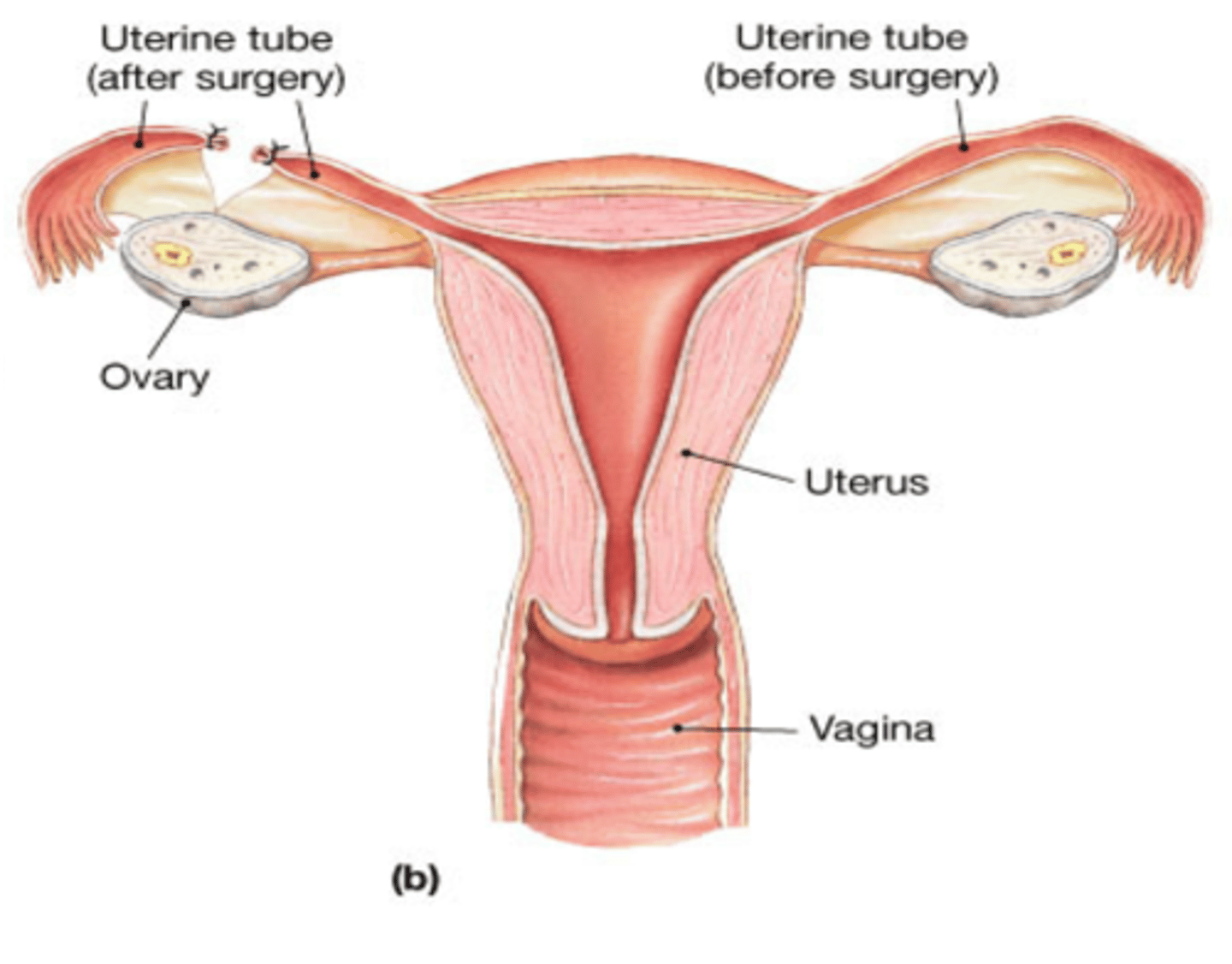 <p>blocking or cutting of the fallopian tubes to prevent fertilization from occurring</p><p>-Permanent method</p>