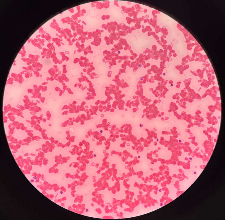 • Type of anemia.

• Genetic mutation causes malformation of hemoglobin.

• Erythrocytes appear rigid and sickle-shaped.