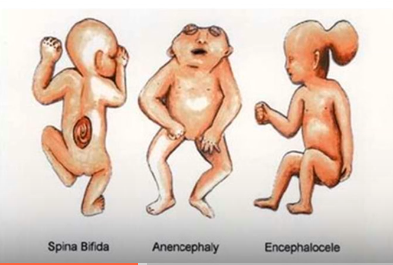 <p>Spina bifida,Anencephaly,Encephalocele</p>