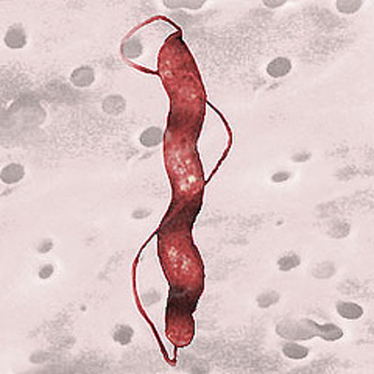 <p>Identify Pathogen causing Diarrhea:</p><p>Gram-negative (comma, spiral, S-shaped) curved rod w/ polar flagella; requires O2 at low levels</p><p>-Hx: </p><p>&gt; Fecal-Oral transmission</p><p>&gt;&gt; Animal Intestines (poultry)</p><p>&gt;&gt; Undercooked poultry (MC = Chicken)</p><p>&gt;&gt; Unpasteurized milk</p><p>&gt;&gt; Contaminated drinking water</p><p>&gt; A/w...</p><p>&gt;&gt; Reactive arthritis (HLA-B27 +)</p><p>&gt;&gt; Guillain-Barre Syndrome</p><p>-Path/Sx/PE:</p><p>&gt; Cholera-like toxin = Watery Diarrhea</p><p>THEN</p><p>&gt; Invade mucosa = Bloody Diarrhea</p><p>-Dx:</p><p>&gt; Culture</p><p>&gt;&gt; Grows at 37C to 42C</p><p>&gt;&gt; (+) Oxidase</p><p>&gt;&gt; Microaerophilic</p><p>&gt; Histology: Acute, self-limited colitis with cryptitis and crypt abscess</p>