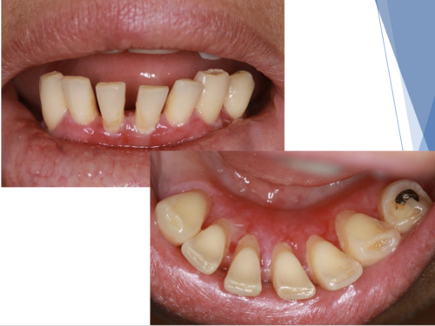 <p>Patient presents with an autoimmune disorder with autoantibodies to hemidesmosomes. What condition do you suspect?</p>