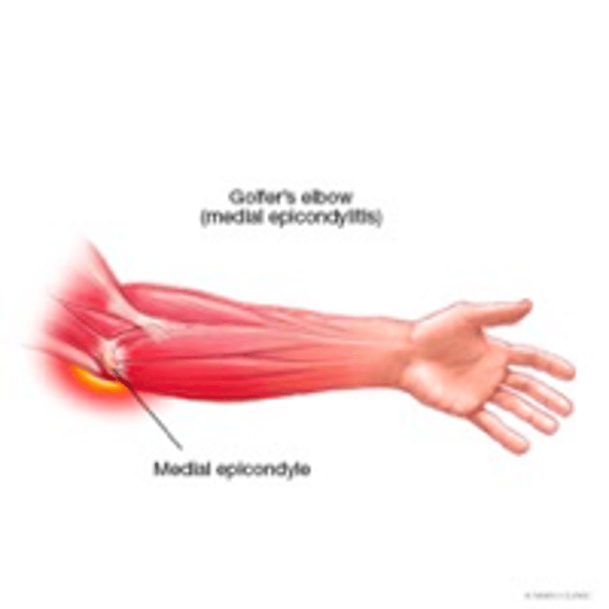 <p>•+/- Edema over medial epicondyle</p><p>•Point tenderness to palpation over medial epicondyle</p><p>•Pain with resisted wrist flexion</p><p>•Elbow stable to valgus stress to rule out UCL involvement</p><p>•Evaluate ulnar nerve to rule out cubital tunnel syndrome (can coexist)</p>