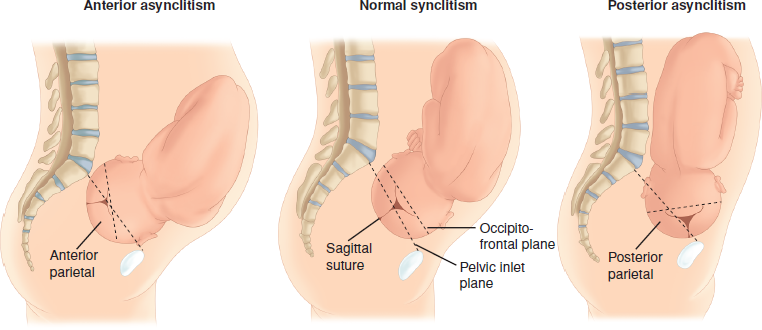 <p>flexão lateral da cabeça <br>Posterior (obliquidade de litzmann): sutura sagital próxima do Púbis e parietal posterior é o primeiro a entrar na escavação pélvica</p>