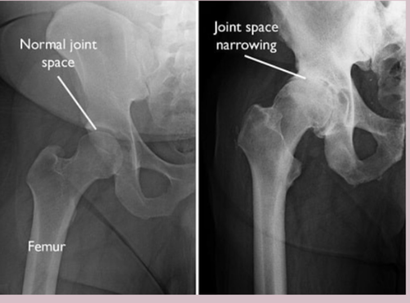 <p>-clinical </p><p>Imaging </p><p>-Xray weight bearing: Asymmetric joint space narrowing</p><p>-subchondral sclerosis, osteophytes, subchondral cysts </p><p>If effusion present </p><p>-synovial fluid analysis: noninflammatory (<2000), clear/yellow, high viscosity </p>