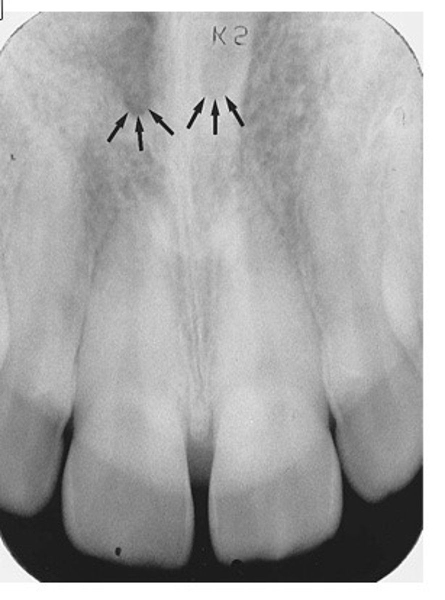<p>What is the radiolucent structure seen here?</p>