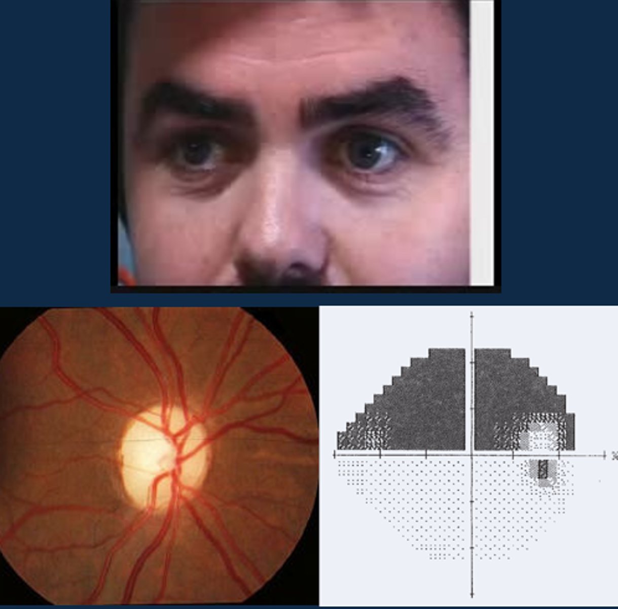 <p>ONH pallour</p><p>dyschromatopsia</p><p>altitudinal VF defect</p><p>ONH NFL dropout</p>