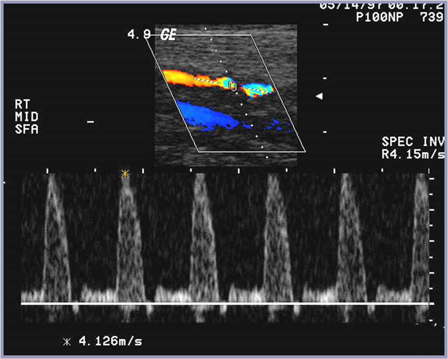 max stenosis PSV = 413cm/s, focally doubled