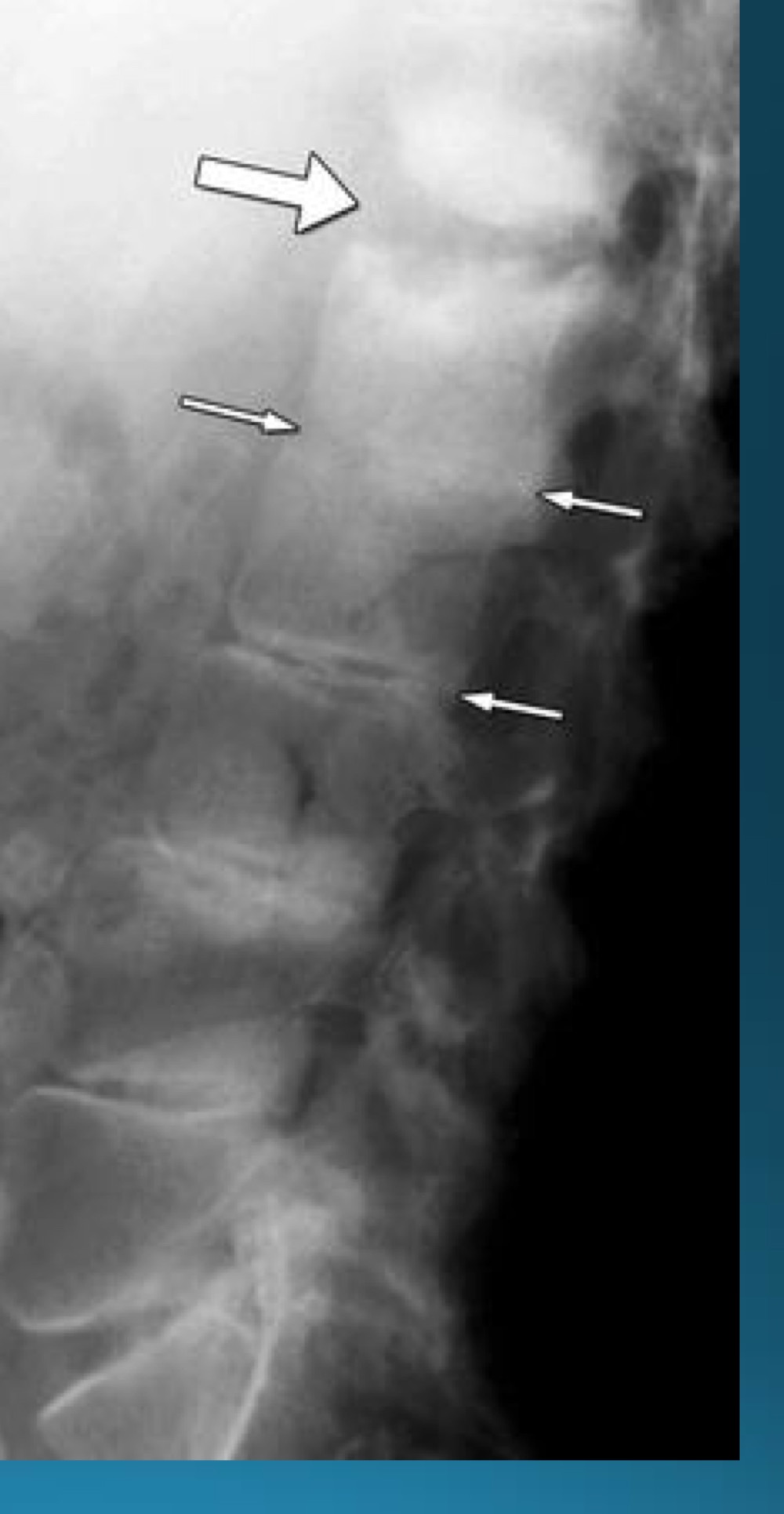 <p>what do you call this sign? what diangosis is this apart of? </p>