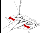 <p>Which type of dissection technique?</p>