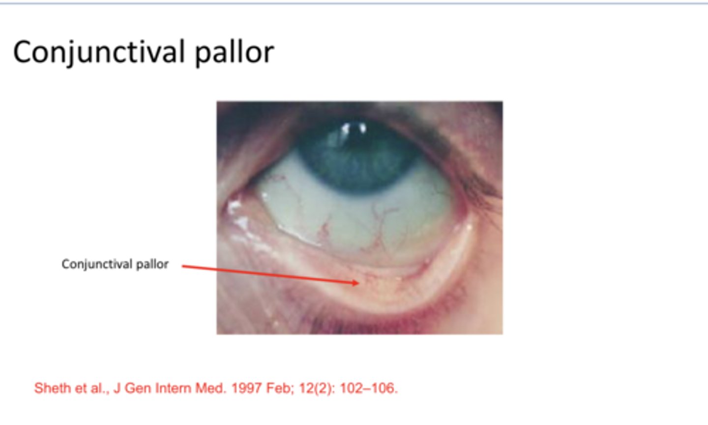 <p>Conjunctival Pallor (Pic)</p>