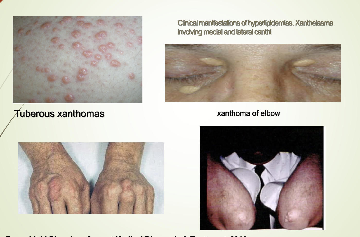 <ul><li><p><span>Eruptive xanthomas on the arm in untreated hyperlipidemia + diabetes mellitus.</span></p></li><li><p><span>Xanthelasma on eyelids.</span></p></li><li><p><span>Tuberous xanthomas.</span></p></li><li><p><span>Elbow xanthomas.</span></p></li><li><p><span>All associated with severe hyperlipidemia.</span></p></li></ul><p></p>