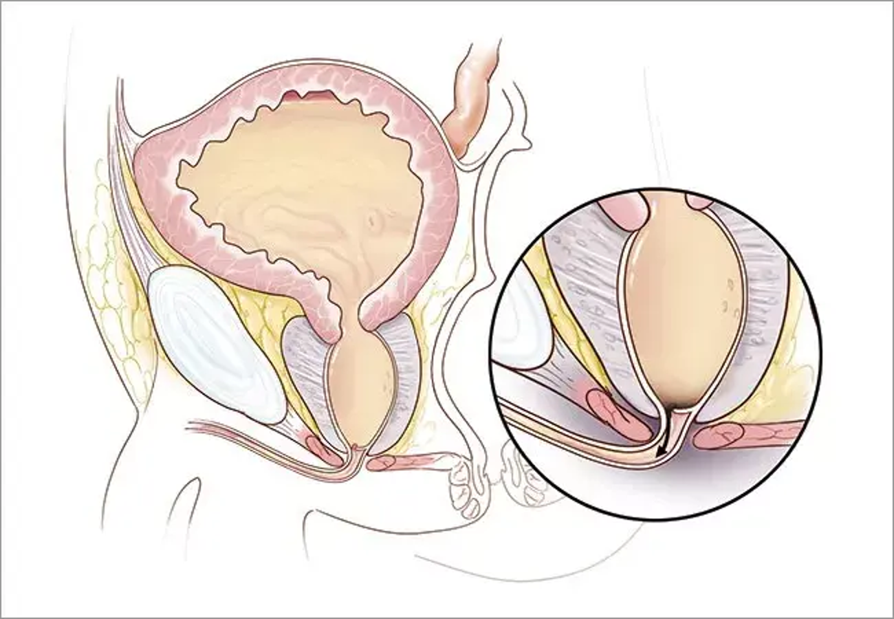 <p>Posterior Urethral Valves</p>