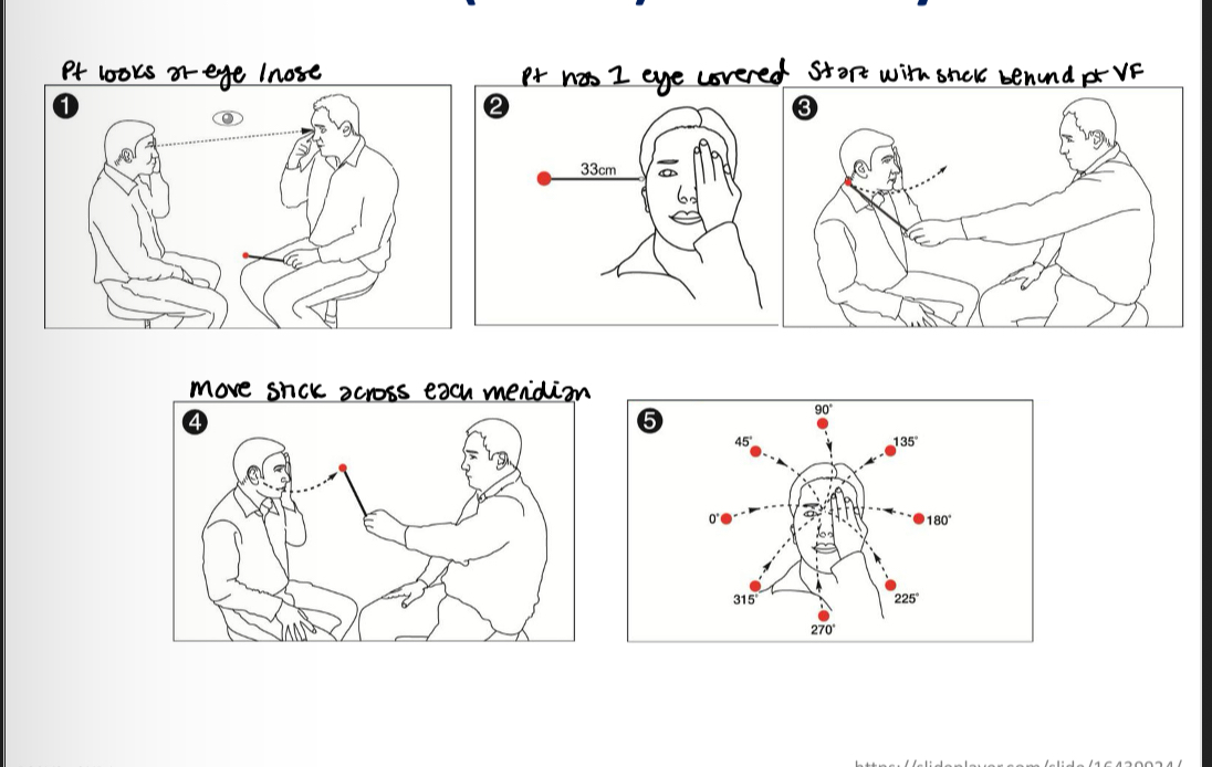 <p>A target is moved from an area of non seen to seen - patient reports when the targett first becomes visible and if the target diappears again </p>