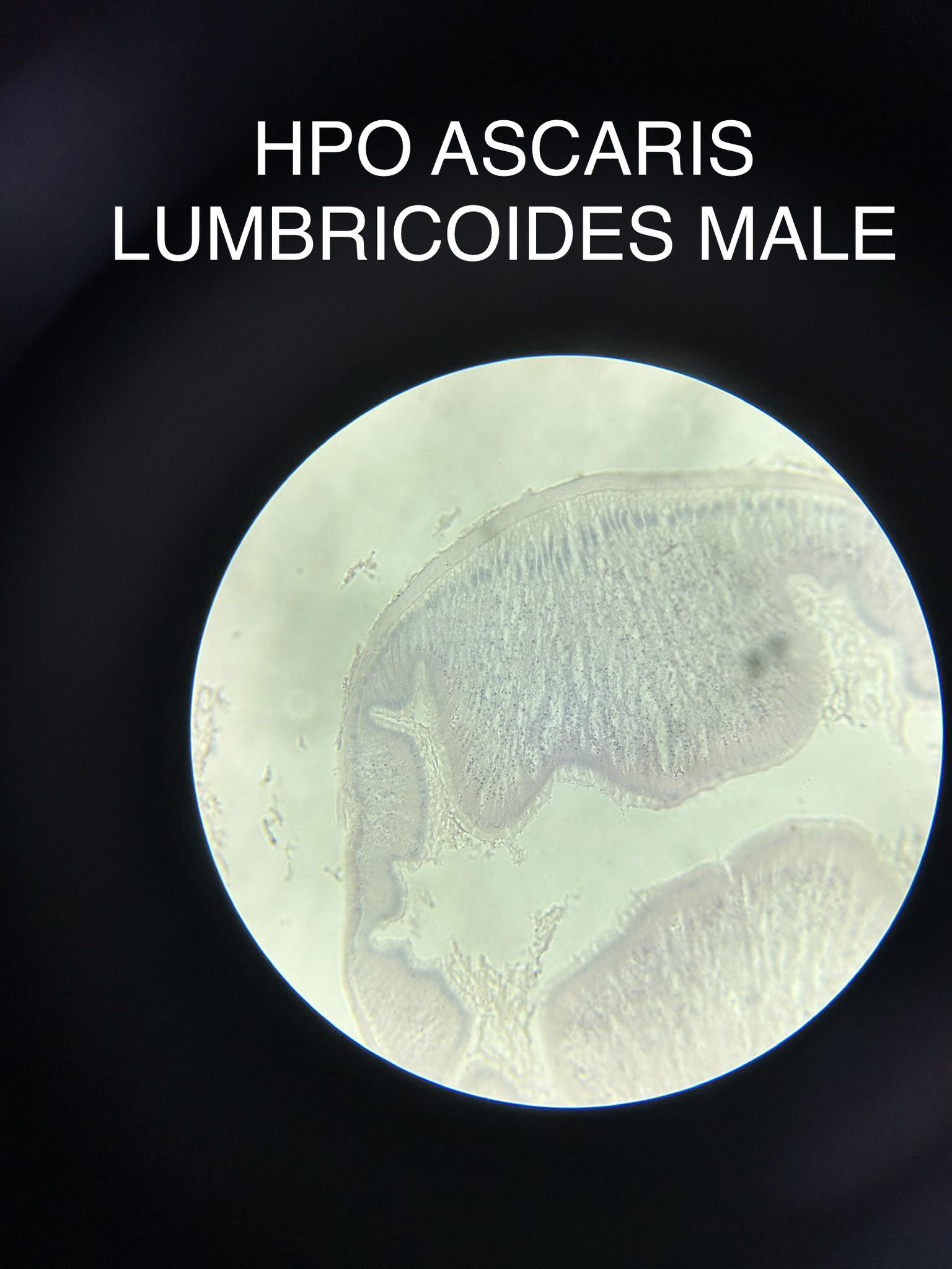 <p>Ascaris Lumbricoides</p>