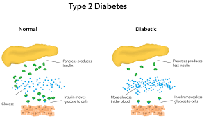 <p>DM Type 2 (Type 2 Diabetes Mellitus)</p>