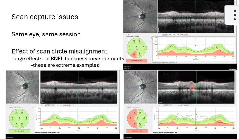 <p>scan capture issues; same eye same session</p>