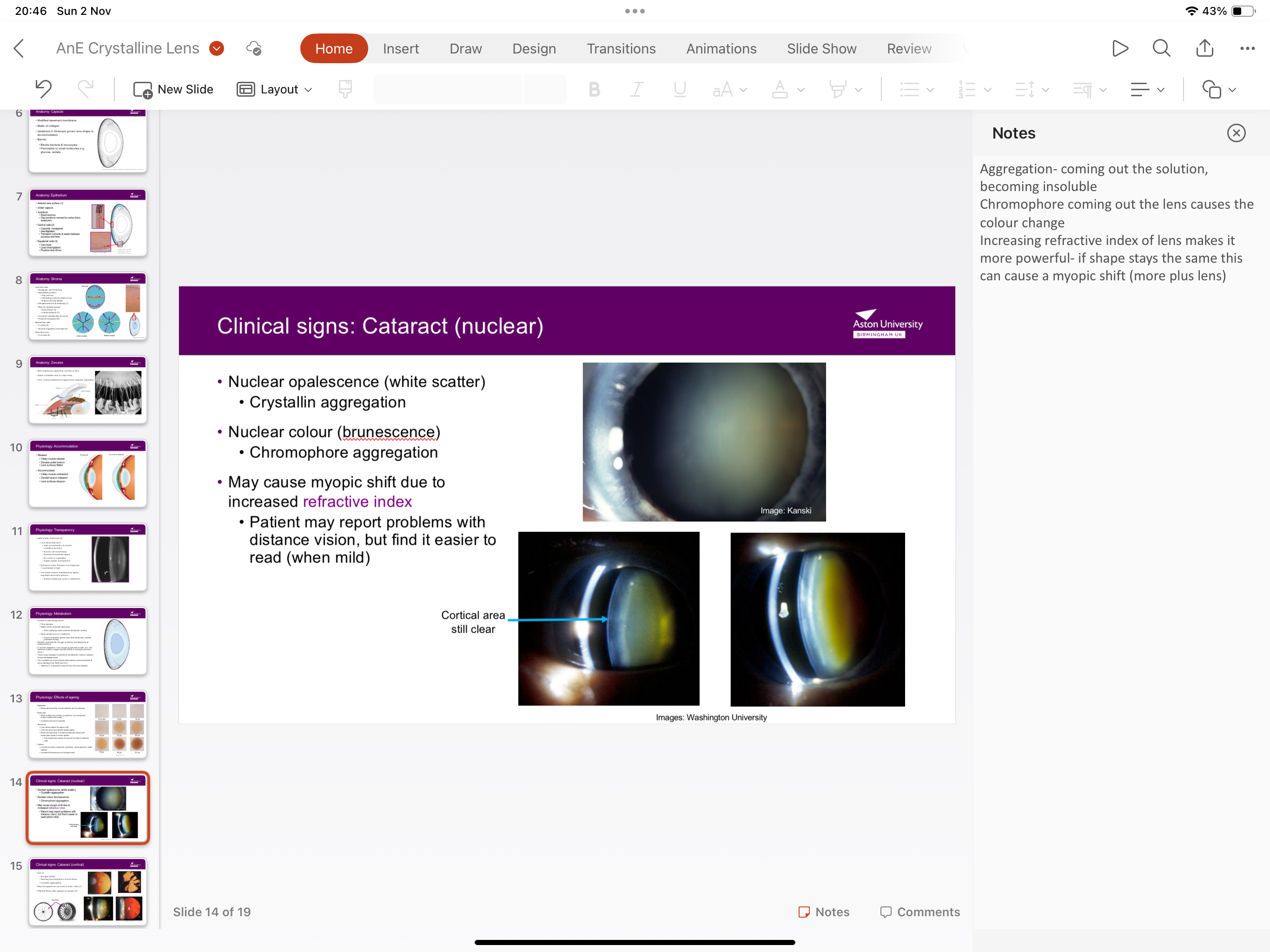 <p>Nuclear oppalescence (white scatter) due to crystallin aggregation (coming out of solution)</p><p>Nuclear brumenescnece due to chromphore aggregation</p>