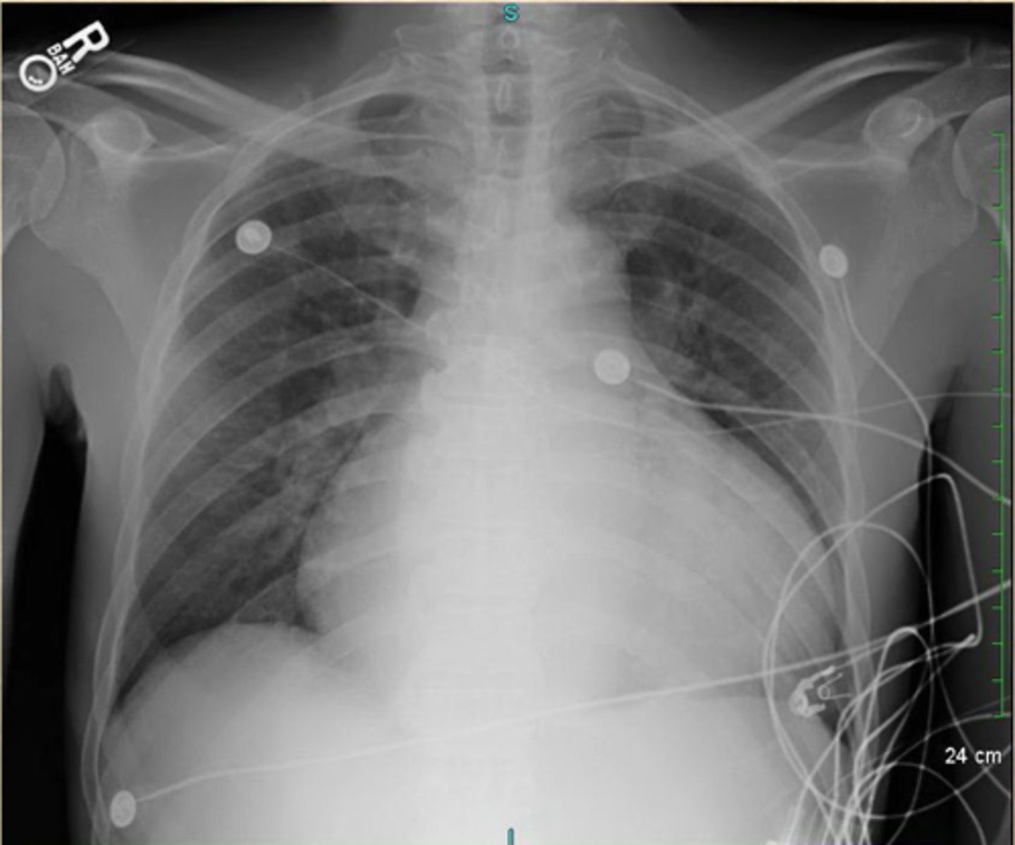 <p>What does this CXR show?</p>