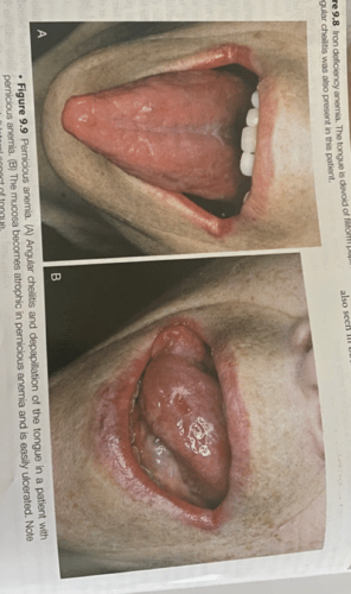 <p>-Vitamin B12 deficiency that is caused by a deficiency of intrinsic factors a substance secreted by the parietal cells of the stomach</p><p>-</p>