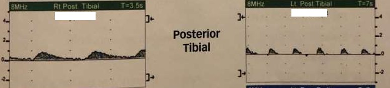 <p>What do the posterior tibial artery waveforms most likely represent? </p><ul><li><p>Describe L &amp; R waveforms</p><ul><li><p>If diseased, where disease is located and if it is inflow/outflow disease</p></li></ul></li></ul><p></p>