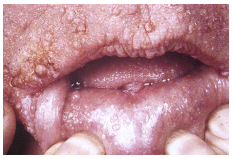 <p>A mutation of the PTEN gene that results in polyps and lipomas throughout the GI tract, trichilemmomas, cerebellar lesions, and an increased risk of cancer in the thyroid, breast, and GU tract</p>