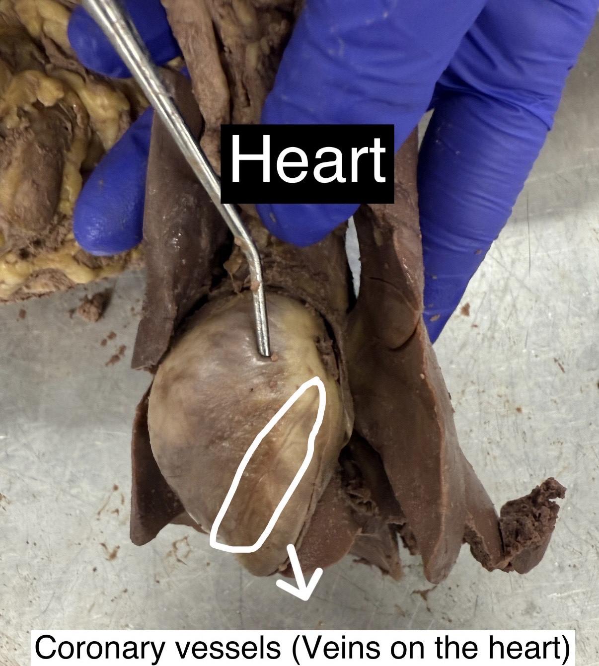 <p>Heart and coronary vessels</p>