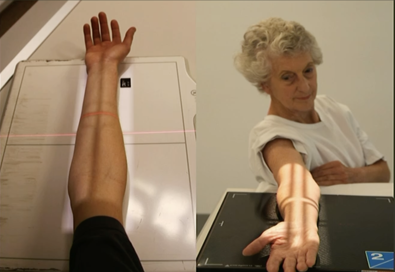 <p>Fine FS, 100cm</p><p>55kVp/2.5mAs</p><p>Straight tube</p><p>CR: Midshaft radius/ulna</p>