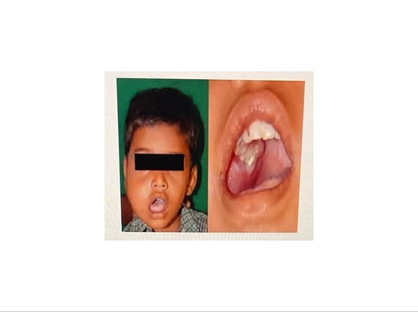 <p>A malignant tumour of striated muscle. Oral cancer in children is uncommon but out of all kids oral cancer, this is the most common. Typically occurs in children under 10, male sex predilection. Rapidly growing, destructive tumour.</p>