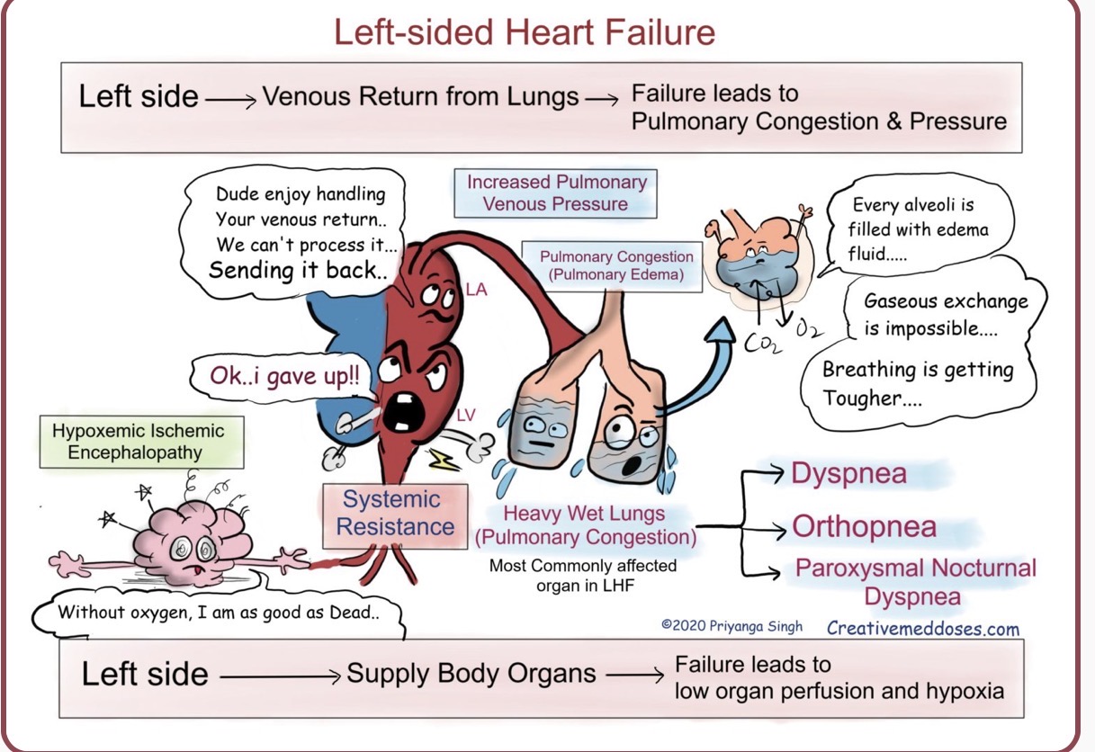 <p>Heart failure type with symptoms including pulmonary congestion, dyspnea, orthopnea, and cough with frothy sputum.</p>