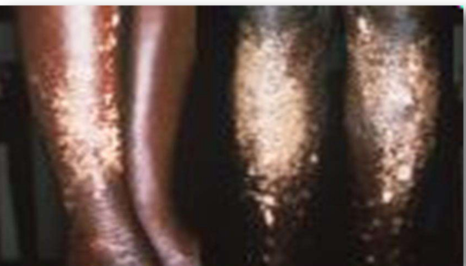 <p>disease; caused by?</p>