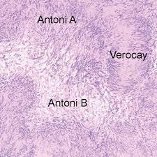 <p>Acoustic neuroma of inner ear</p><p>M/P: Typically show a biphasic appearance with: Antoni A and Antoni B areas. Antoni A Areas: hypercellular areas with the pathognomonic Verocay Bodies Antoni B Areas: hypocellular areas of loose meshwork of Schwann cells.</p>