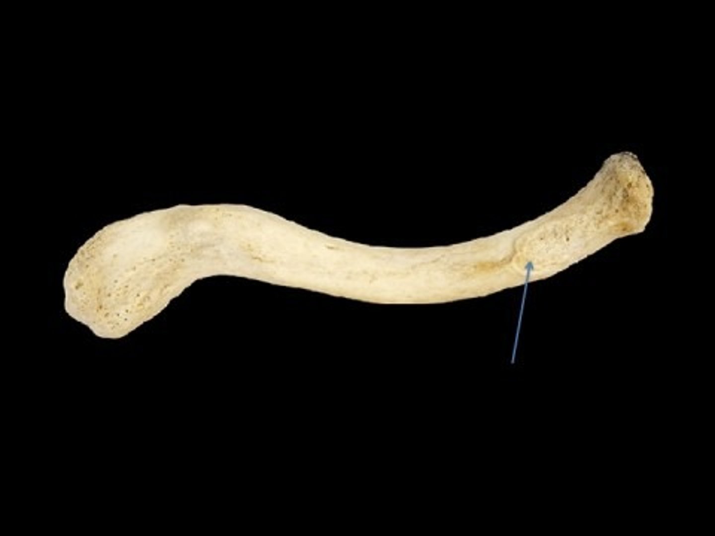 <p>broad, roughened spot on the inferior surface of the medial aspect of the clavicle (attachment point for the costoclavicular ligament)</p>