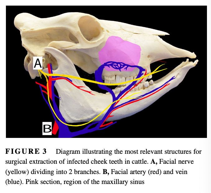 <p>Objective: To report the clinical presentation, treatment, and outcome of cattle undergoing surgical extraction of apically infected cheek teeth (CT)</p><p>Results:</p><ul><li><p>Main presenting complaints were mandibular swelling and decreased appetite and milk production</p></li><li><p>7 mandibular and 3 maxillary CT were extracted, 7 molars and 3 premolars that were distributed more frequently on the left dental arcades</p></li><li><p>Two cattle had no visible external lesions</p></li><li><p>Radiograph images revealed that lucency surrounded all affected tooth roots</p></li><li><p>Mandibular teeth were removed by lateral buccotomy with removal of alveolar bone plate or retrograde repulsion and maxillary teeth were removed by repulsion through a maxillary sinus flap</p></li><li><p>Most common bacterial isolates consisted of anaerobic bacteria (6/11 isolates) and Truperell pyogenes (3/11 isolates)</p></li><li><p>Most common complicatoins included inability to remove the tooth intact (4 cattle) and surgical site infection (5)</p></li><li><p>All cattle remained in their herd after treatment</p></li></ul><p>Conclusion: Surgical extraction of CT was achieved in all 9 cattle. The postoperative morbidity was high but without long-term consequences on animal productivity</p>