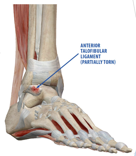 <p>1st degree sprain</p>