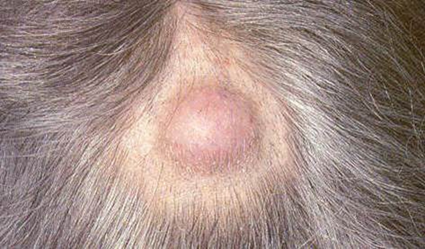 <p>Pilar cyst (Wen)</p>