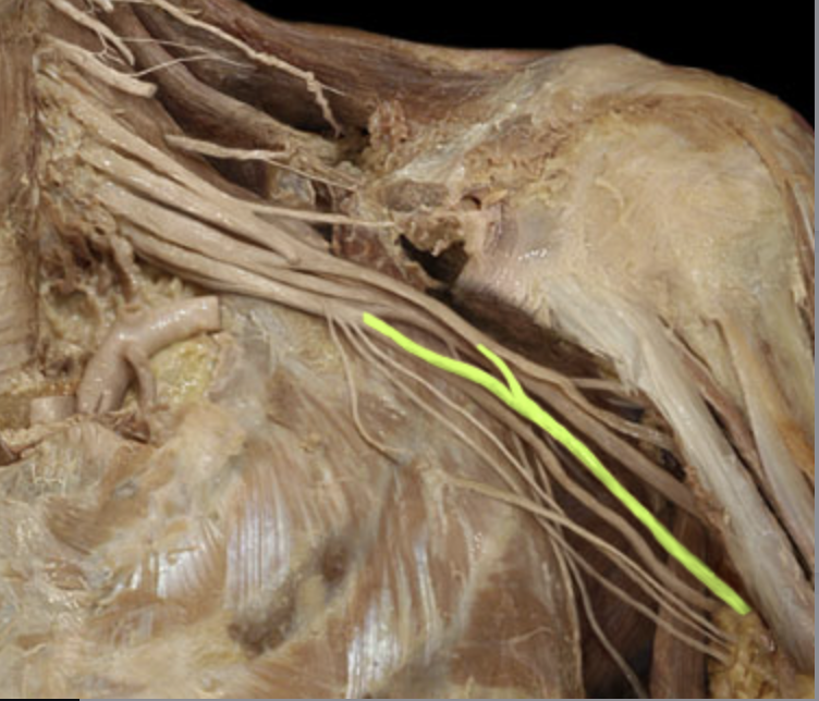 <p><em>table 7, medial/lateral cord terminal branch</em><br><em>supplies</em> <span><em>flexor compartment of forearm, thenar mm, lumbricals 1 &amp; 2</em></span></p>