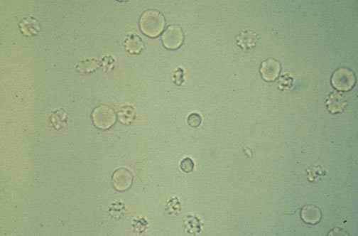 <ul><li><p>abnormal in any number</p></li><li><p>may be crenated or “ghost” cells</p></li></ul><p></p>