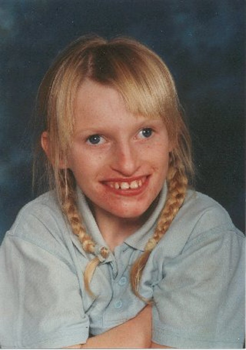 <p>Chromosome 15</p><p>seizures, stiff and jerky gait, laughter and happy demeanor, excitable, short attention span,</p><p>No or few words; nonverbals and verbal receptive skills much higher than expressive skills</p>