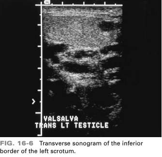 <p>which complications is associated with this abnormality (varicocele)</p>