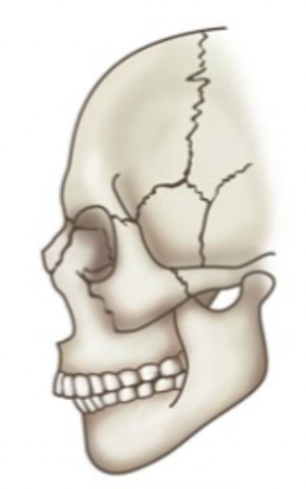 <p>increased overjet; appearance of receding chin and decrease in lower facial height, “overbite” </p>