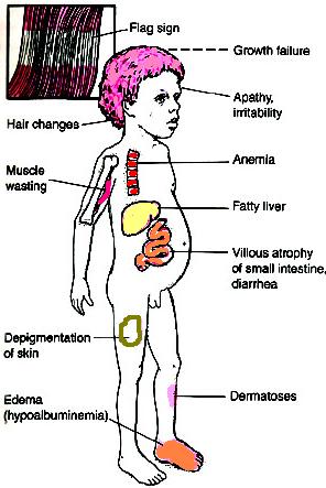 <p>Kwashiorkor</p>