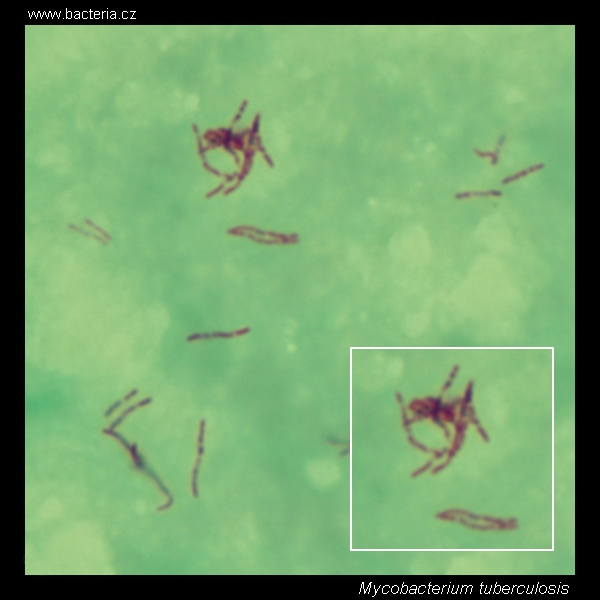 <p><strong>Acid-fast rod</strong> (special stain, not classic Gram, but technically weakly <strong>Gram-positive</strong>).</p><p></p><p>Type: Bacteria;</p><p>Disease: Tuberculosis (TB) — usually in lungs, can spread elsewhere;</p><p>Diagnosis: Chronic cough (sometimes with blood), chest X-ray, TB skin test, lab tests on sputum</p><p>Treatment/Prevention: Long course of antibiotics (isoniazid + rifampin, etc.); BCG vaccine used in some countries;</p><p>Spread/Unique: Airborne droplets; waxy cell wall makes it very tough and able to stay dormant (latent TB).</p><p></p>