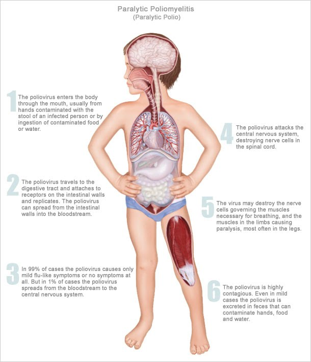 <p>On the extreme end, what can Polio virus lead to?</p>