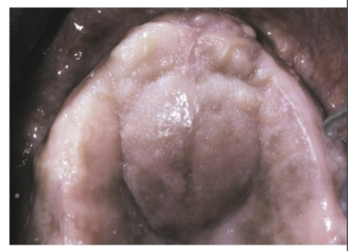 <p>What are the three presenting symptoms of Nasopalatine duct cyst? </p>