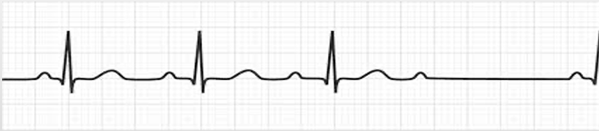 <p>irregular, increasing PR intervals followed by a dropped beat -cycle repeats</p>
