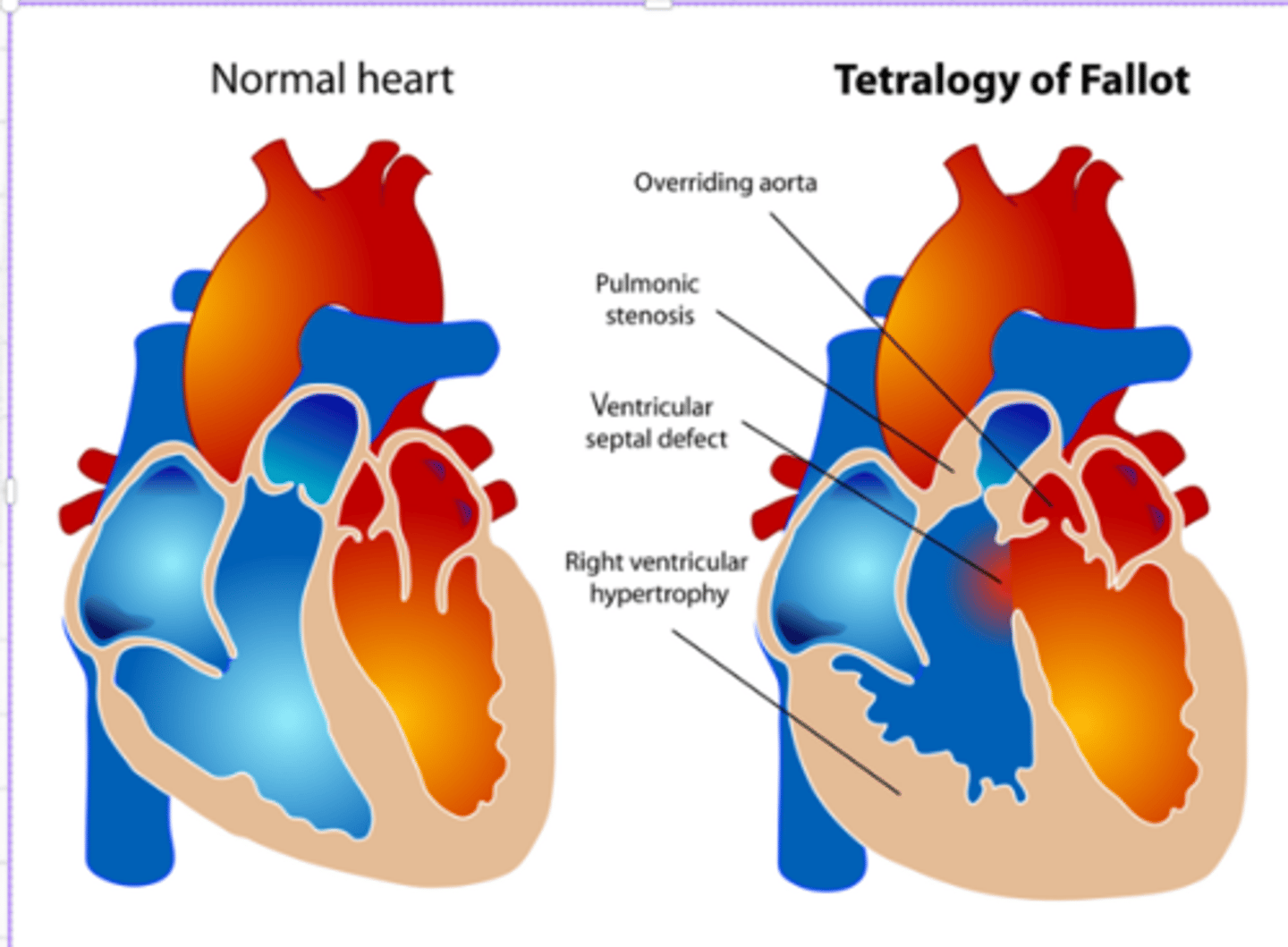 <p>Four Heart Defects that occur at once</p><p>- poor pulmonary flow</p><p>RAPS</p><p>1. Right ventricle Hypertrophy: The right lower chamber of the heart is bigger or thicker than normal, making it harder for blood to go through the pulmonary valve</p><p>2. Aorta Displacement: </p><p>- The aorta, which is the artery that carries oxygen-rich blood to the body, is out of place and rises above both ventricles. As a result, the body gets too much oxygen-poor blood.</p><p>1. Pulmonary stenosis: </p><p>- It is a narrowing of the pulmonary valve or pulmonary artery just distal to the valve. pulmonary valve does not open properly</p><p>2. Septal defect (VSD): </p><p>- VSD is a hole between the two lower chambers (ventricles) of the heart. The hole allows oxygen-rich blood and oxygen-poor blood to mix, so the body does not receive enough oxygen-rich blood.</p>